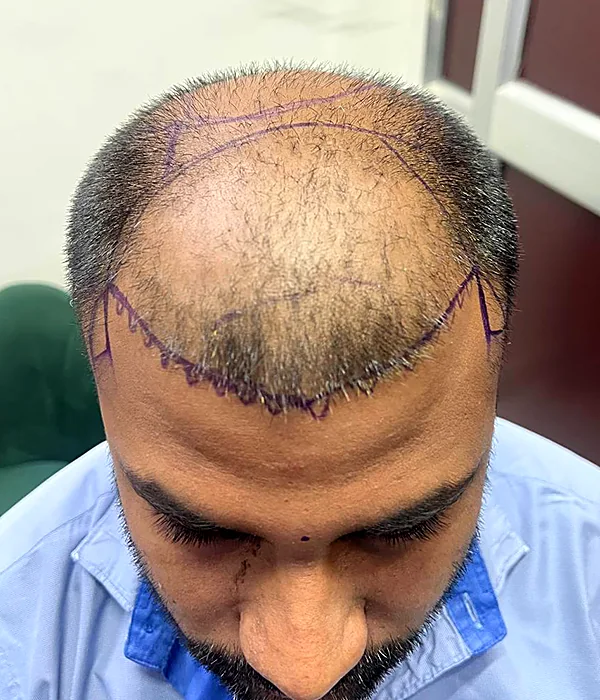 Before hair transplant