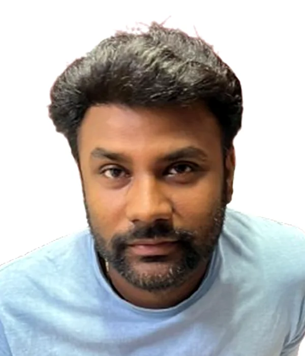 After hair transplant at Elegant Clinic